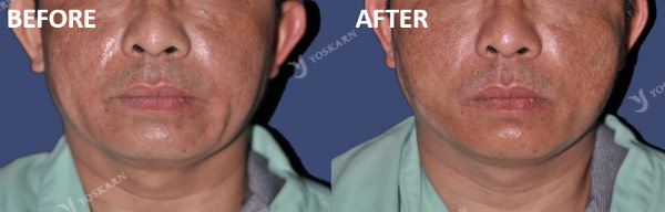 threadlift1