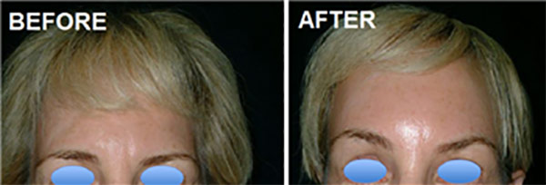 Forehead-lift