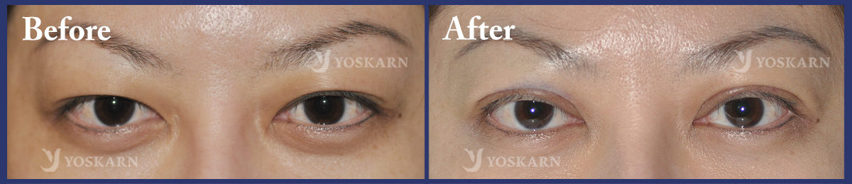 Upper Lid Plasty
