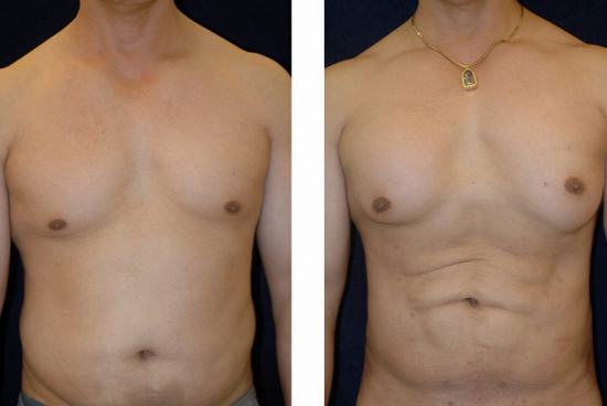 Liposuction