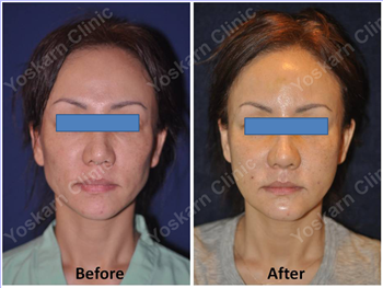 Fat Transfer
