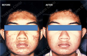 Acne Extraction