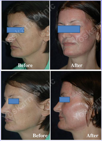 Laser Skin Resurfacing