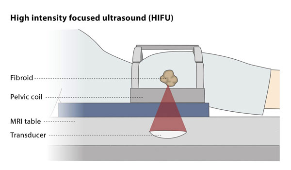 HIFU Treatment