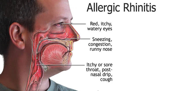 Allergic Rhinitis