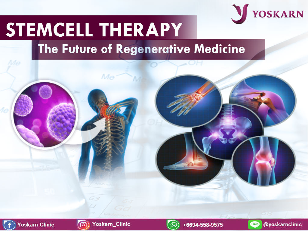 Stem Cell Therapy