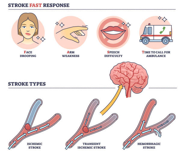 Stem Cell Therapy for Stroke Rehabilitation