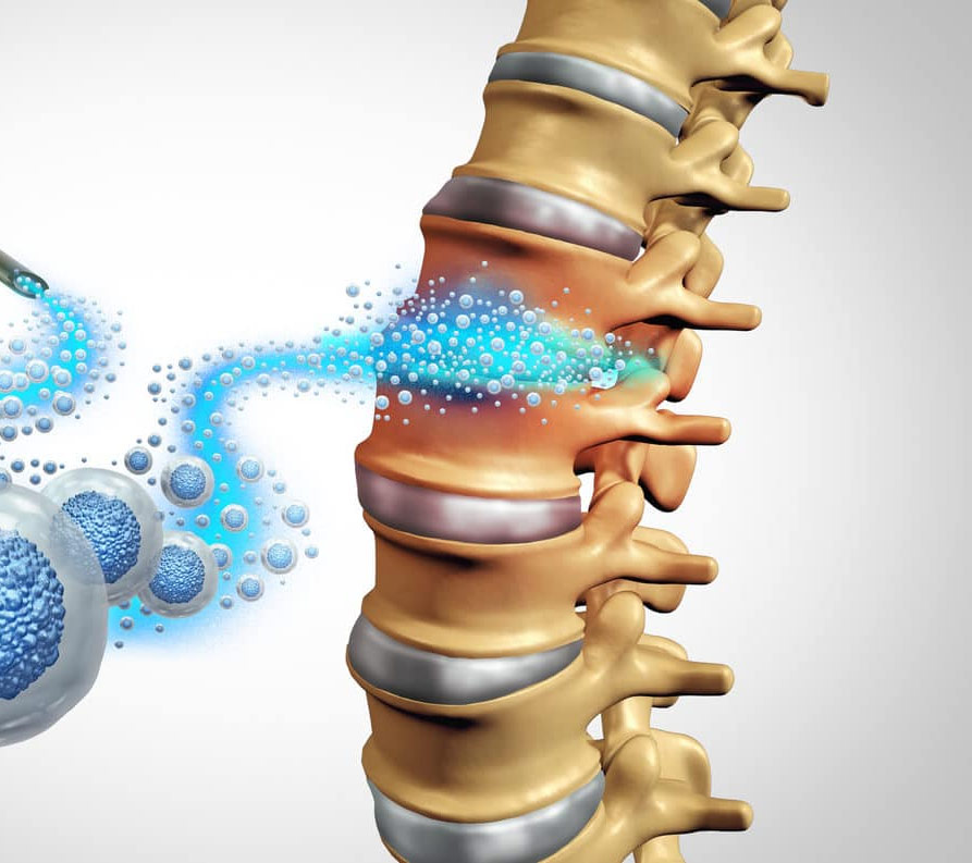 Stem Cell Therapy for Degenerative and Autoimmune Conditions
