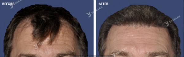 Hair Transplant