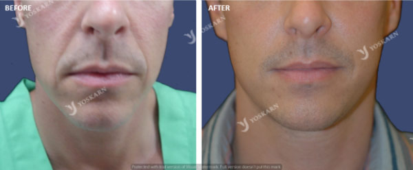 minifacelift.jpg