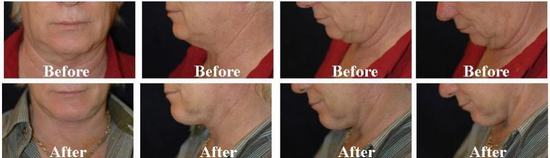 Neck-contouring-2.jpg