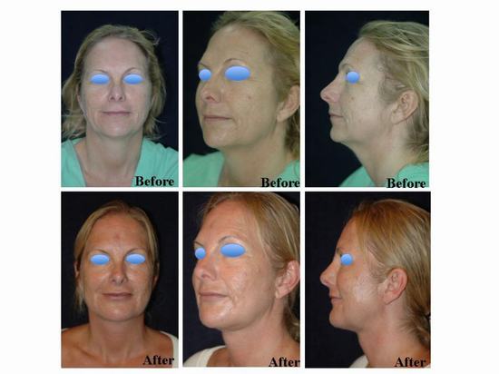 Neck-contouring2.jpg
