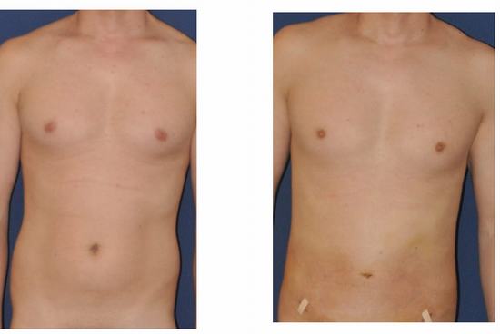 Liposuction.jpg