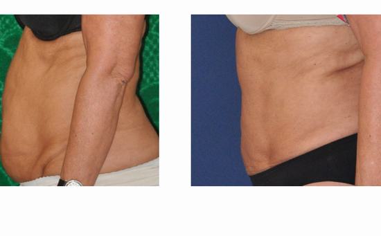 Liposuction4.jpg