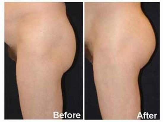 Bodylift-2.jpg