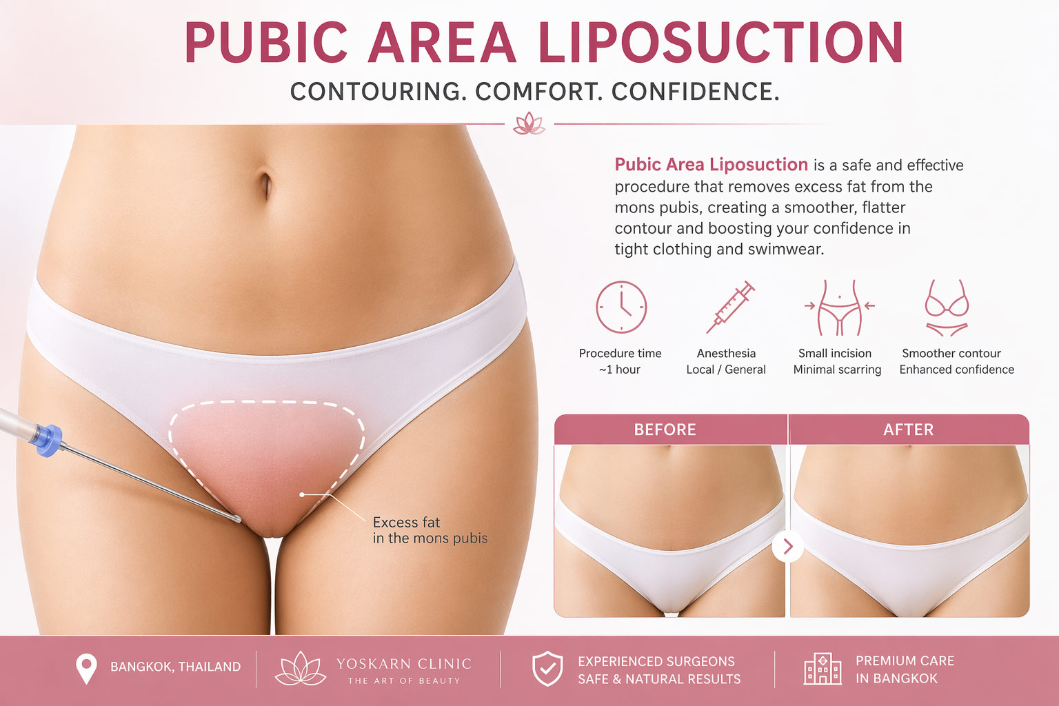 Pubic-Area-Liposuction2.jpg