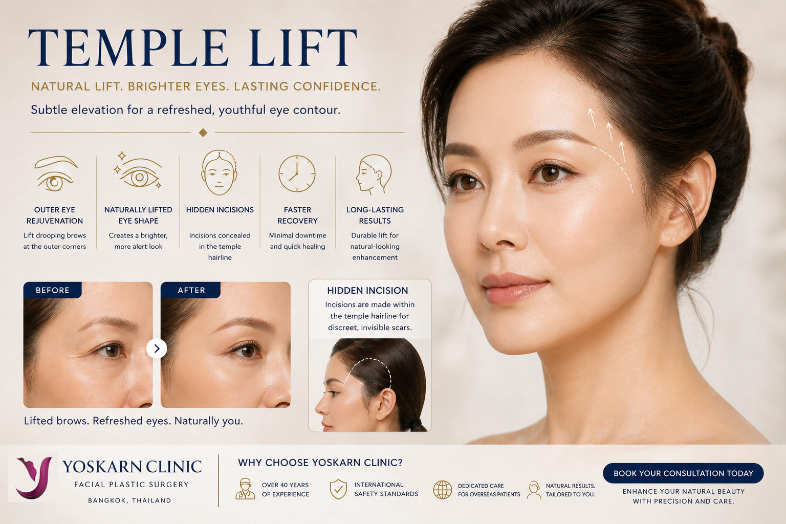 Templelift